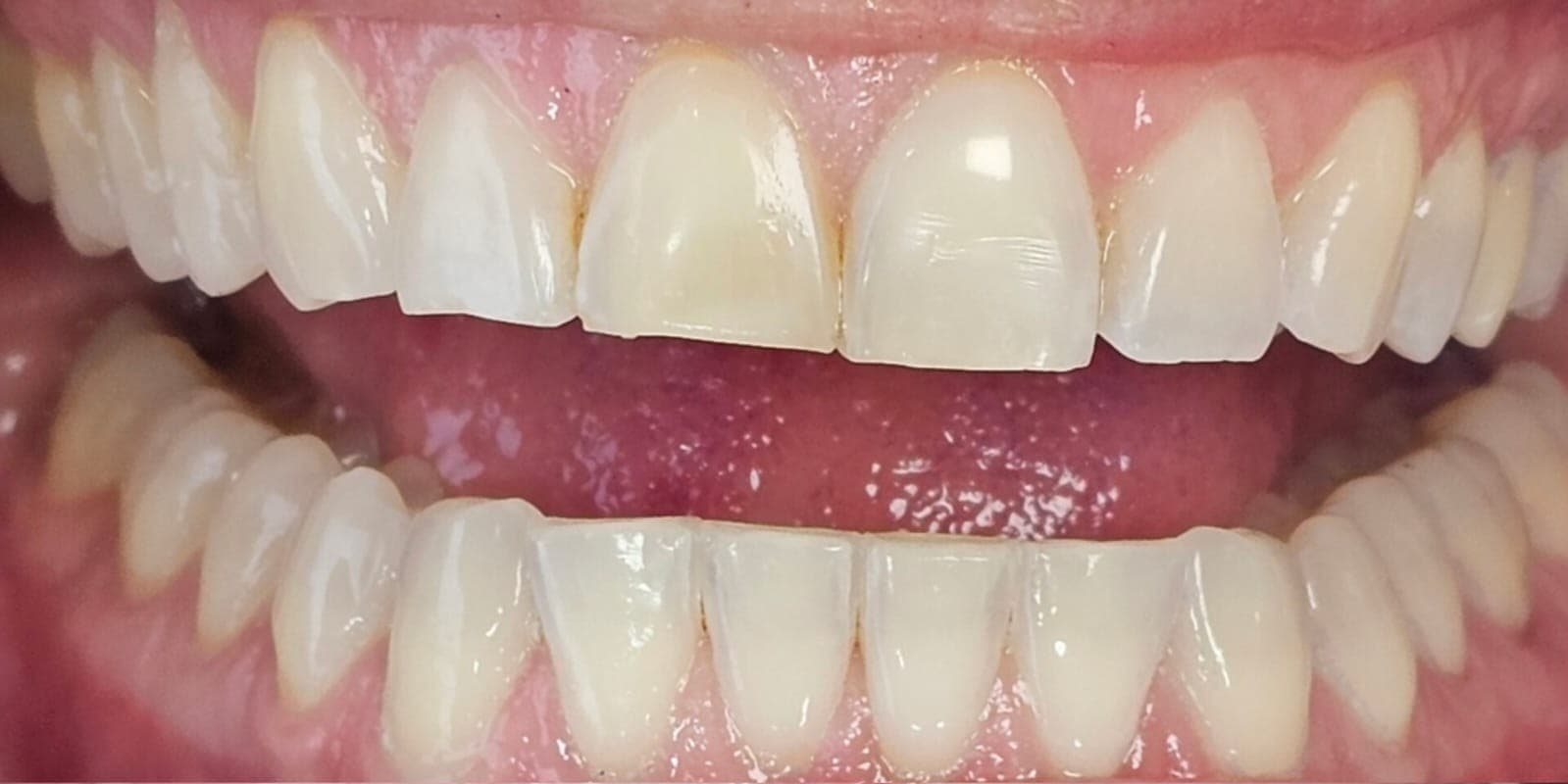 Arcada dental antes do protocolo de clareamento e recontorno