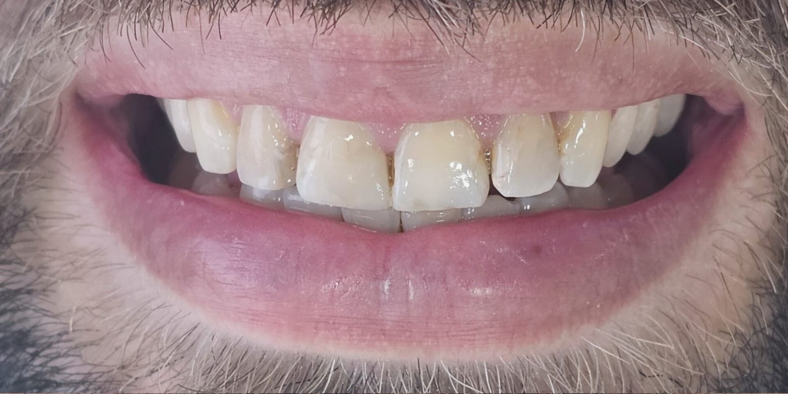 Sorriso masculino com desgastes e alterações de cor antes do tratamento