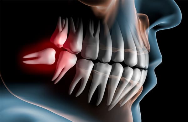 Ilustração de sisos inclusos pressionando os dentes vizinhos, indicação frequente de cirurgia